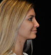Rhinoplasty case #15283