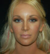Revision Rhinoplasty case #15076