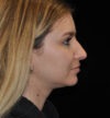 Rhinoplasty case #15283