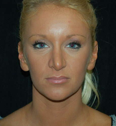 Revision Rhinoplasty case #15076