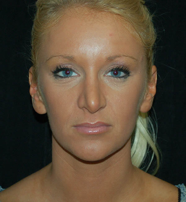 Revision Rhinoplasty case #15076