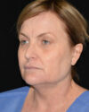 Facelift case #15020
