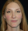 Rhinoplasty case #15278