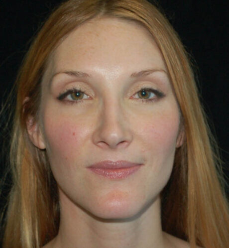 Rhinoplasty case #15278