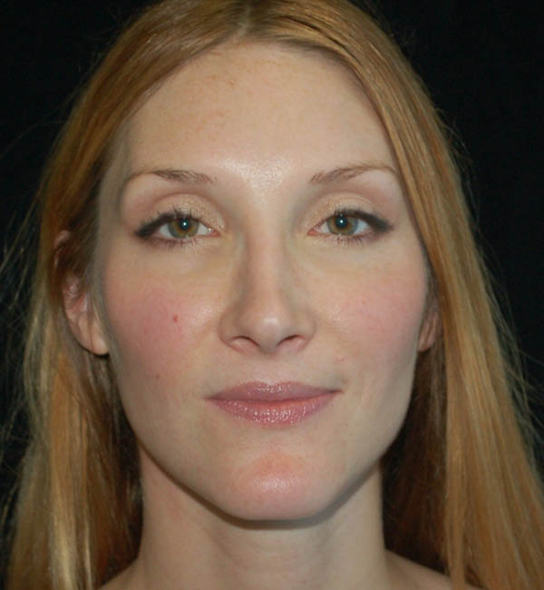 Rhinoplasty case #15278