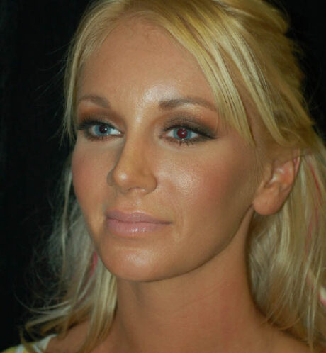 Revision Rhinoplasty case #15076
