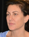 Facelift case #15025