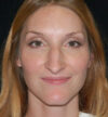 Rhinoplasty case #15278