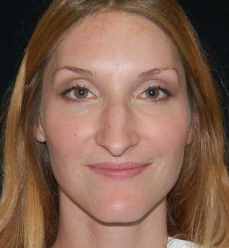 Rhinoplasty case #15278