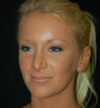 Revision Rhinoplasty case #15076
