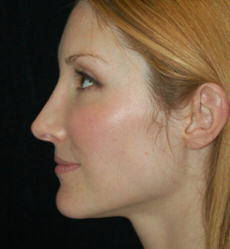 Rhinoplasty case #15278