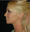 Revision Rhinoplasty case #15076