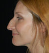 Rhinoplasty case #15278