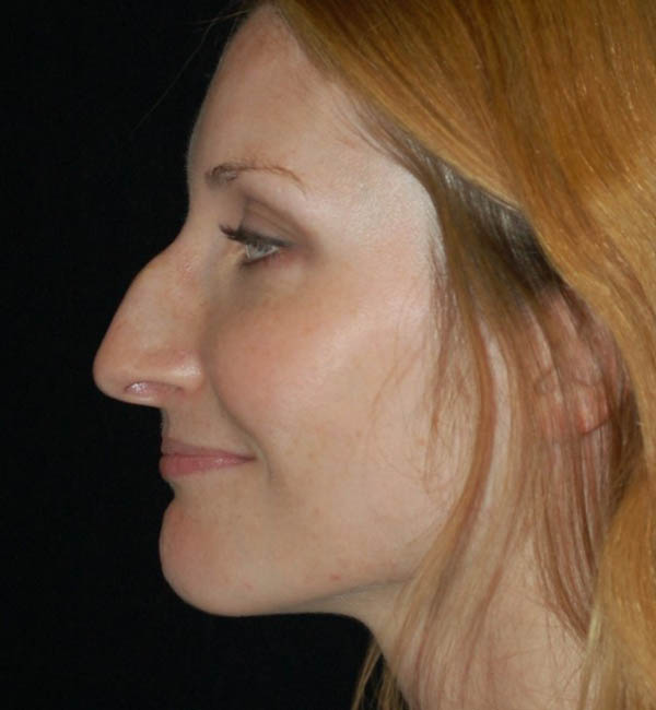 Rhinoplasty case #15278
