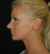 Revision Rhinoplasty case #15076