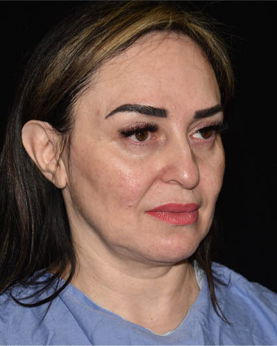 Facelift case #15015