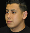 Revision Rhinoplasty case #15083