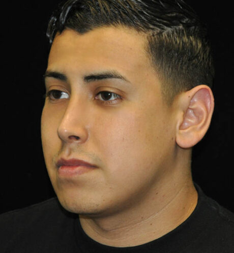 Revision Rhinoplasty case #15083