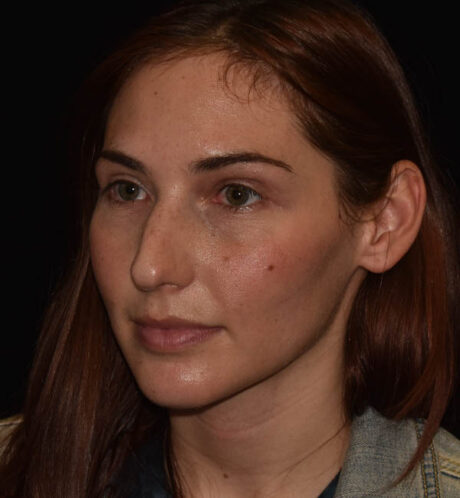 Rhinoplasty case #15275