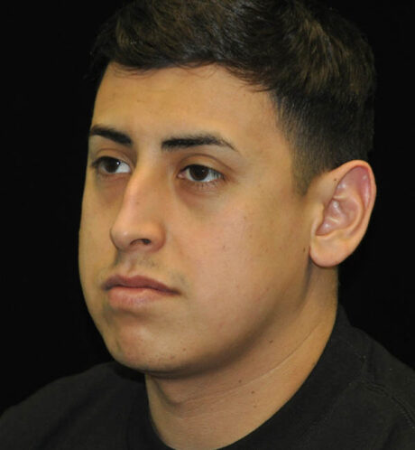 Revision Rhinoplasty case #15083