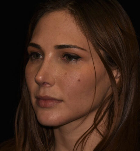 Rhinoplasty case #15275