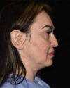 Facelift case #15015