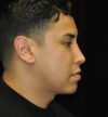 Revision Rhinoplasty case #15083