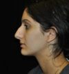 Rhinoplasty case #15333