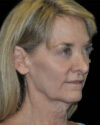 Facelift case #15010