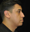 Revision Rhinoplasty case #15083