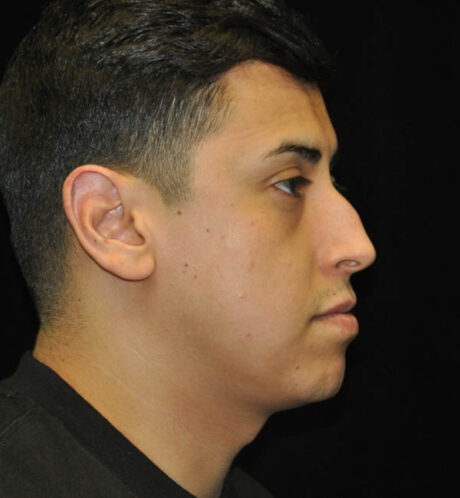 Revision Rhinoplasty case #15083