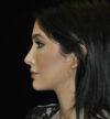 Rhinoplasty case #15333