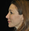Revision Rhinoplasty case #15088
