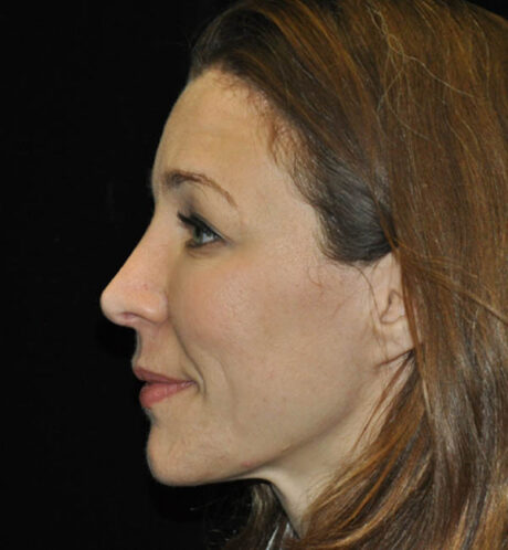 Revision Rhinoplasty case #15088