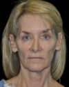 Facelift case #15010
