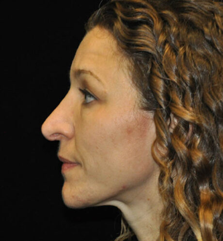 Revision Rhinoplasty case #15088