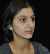 Rhinoplasty case #15333