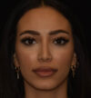 Rhinoplasty case #15326