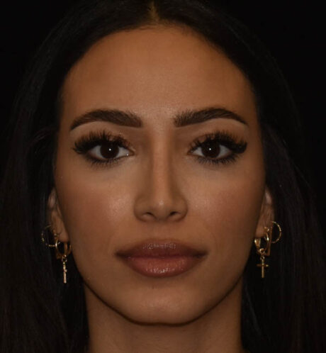 Rhinoplasty case #15326
