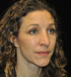 Revision Rhinoplasty case #15088