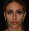 Rhinoplasty case #15326
