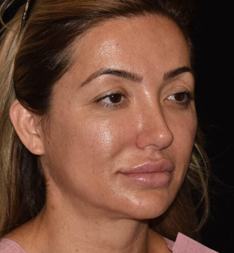 Revision Rhinoplasty case #15093
