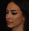 Rhinoplasty case #15326