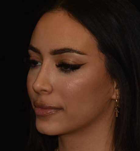 Rhinoplasty case #15326