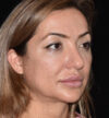 Revision Rhinoplasty case #15093