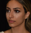 Rhinoplasty case #15326