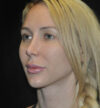 Revision Rhinoplasty case #15096