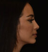 Rhinoplasty case #15326