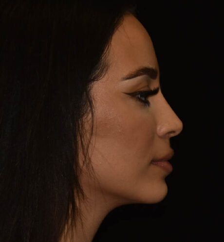 Rhinoplasty case #15326