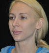 Revision Rhinoplasty case #15096